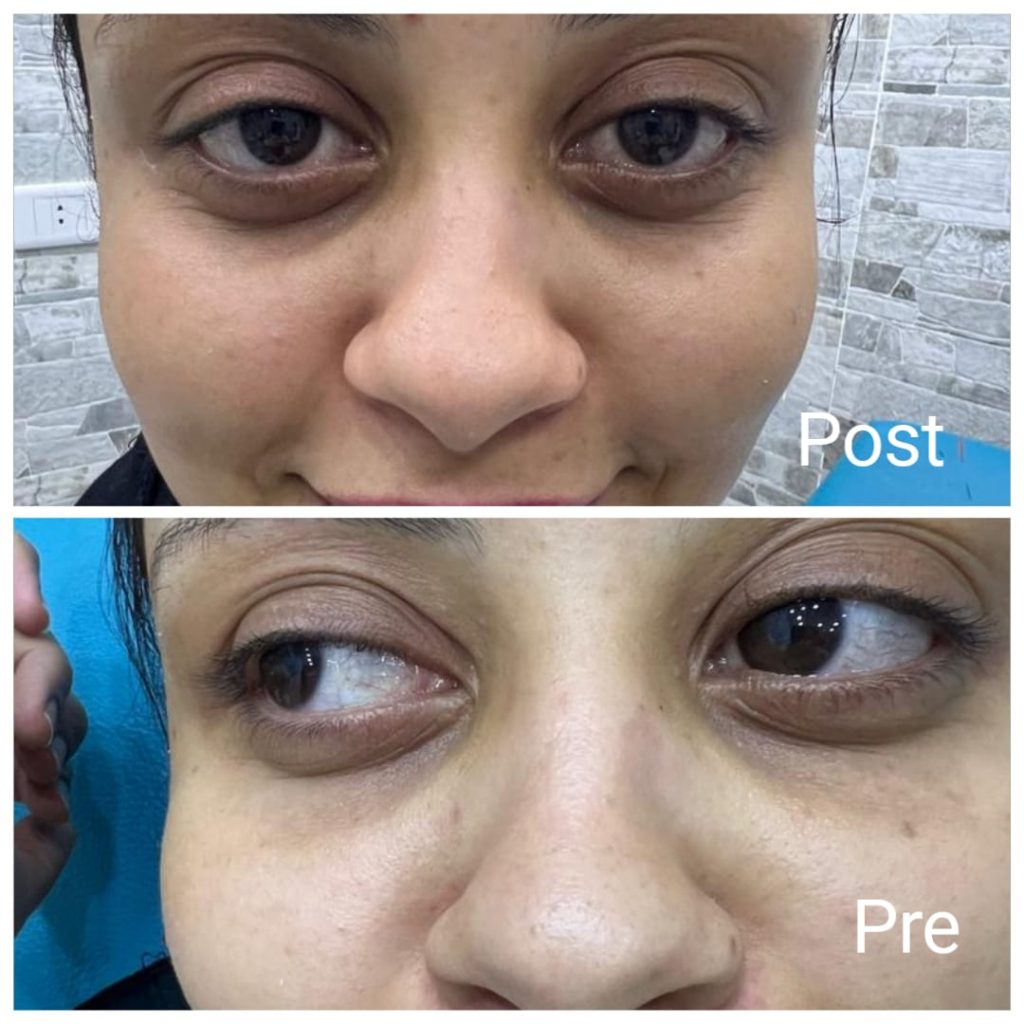 لعلاج التجويف مع فيلر تحت العين في الغردقة